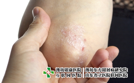 攝圖網_502556199_手肘上的絲蟲（企業商用）