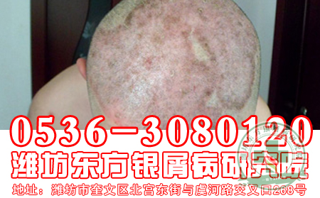 頭上有牛皮癬，理想經常洗頭發嗎
