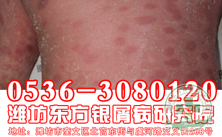 哪種居住環(huán)境易患牛皮癬