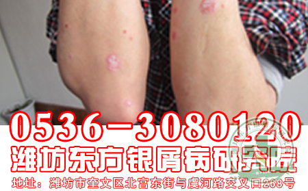 牛皮癬患者在補(bǔ)充營養(yǎng)的時候是否可使用魚