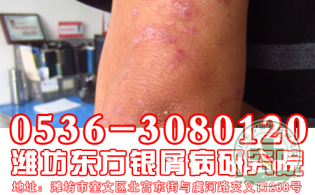 關(guān)節(jié)型牛皮癬怎么治療?