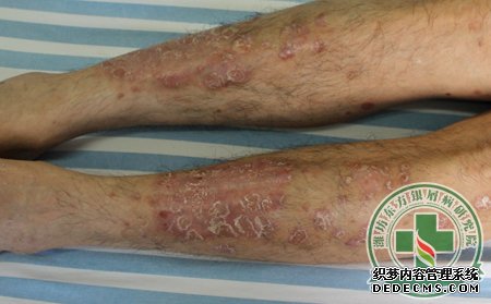 詳細為銀屑病患者介紹不同的銀屑病癥狀表現(xiàn)