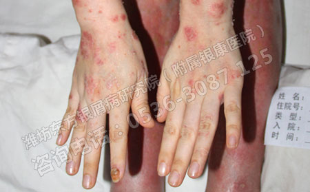 剛患上牛皮癬怎么治療不會(huì)加重病情