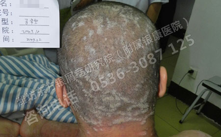 頭部出現(xiàn)牛皮癬怎么治療理想？