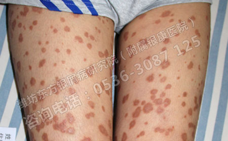 銀屑病會(huì)對(duì)女性患者造成哪些危害?