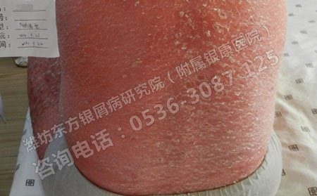 濟(jì)南銀屑病醫(yī)院治療銀屑病的優(yōu)點