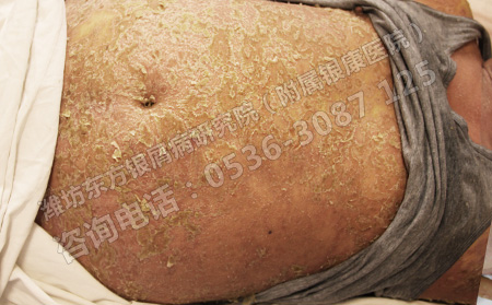 銀屑病患者要怎樣進(jìn)行保健護(hù)理