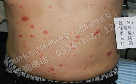 濟南專門治療銀屑病醫院地址