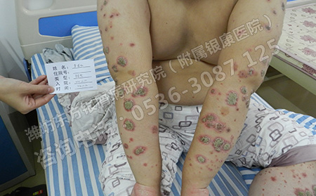 女性銀屑病要注意哪些問(wèn)題