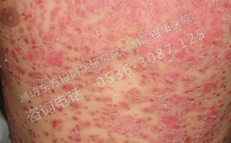 兒童銀屑病要避免那些治療誤區(qū)