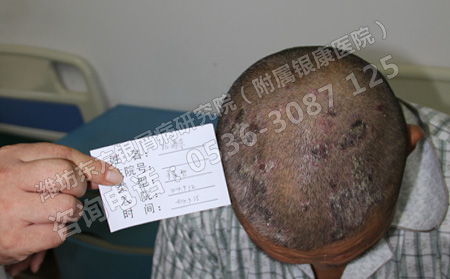 頭上出現了銀屑病癥狀怎么治療