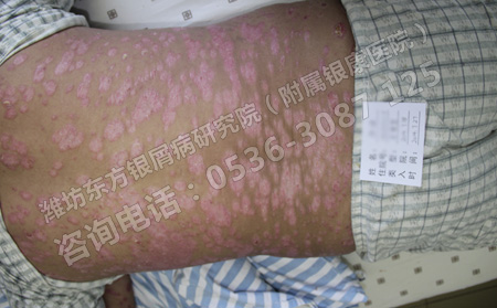 皮膚上出現白色鱗狀物是不是銀屑病呢