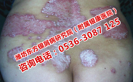 濟(jì)南看牛皮癬理想的醫(yī)生在哪里