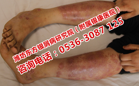 濟南治牛皮癬哪家醫(yī)院理想