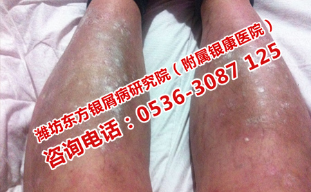 亂用激素對(duì)牛皮癬的危害