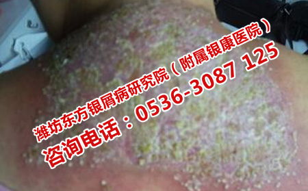 濟(jì)南治牛皮癬的理想醫(yī)院