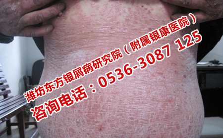 全身嚴(yán)重牛皮癬怎么治