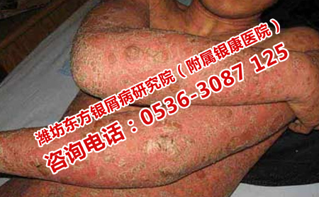 如何對(duì)牛皮癬治療減少復(fù)發(fā)