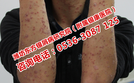 長(zhǎng)清哪里看男性牛皮癬理想