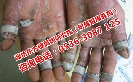 濟(jì)南銀屑病研究院怎樣