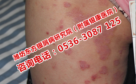 牛皮癬治療不及時(shí)的危害