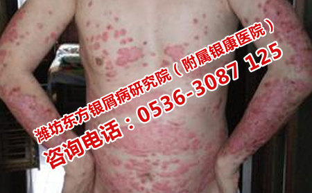 銀屑病復發(fā)了去哪里治