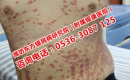 濟南理想的中醫(yī)治療銀屑病的醫(yī)院