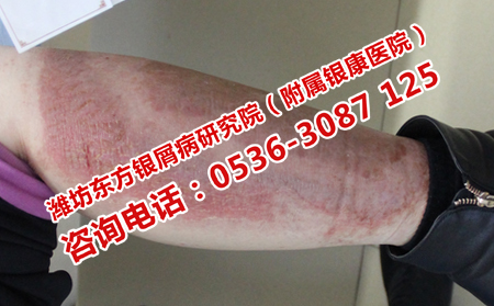 治療銀屑病的專門醫院