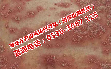 設么樣的醫(yī)院治銀屑病有效