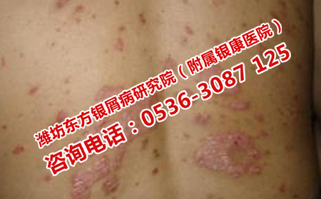 濟(jì)南銀屑病醫(yī)院治療怎么樣