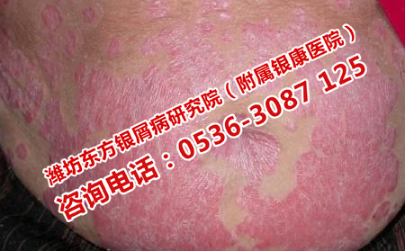 濟(jì)南銀屑病醫(yī)院治療全身銀屑病