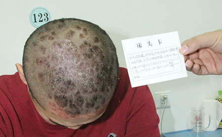 銀屑病如何護(hù)理理想